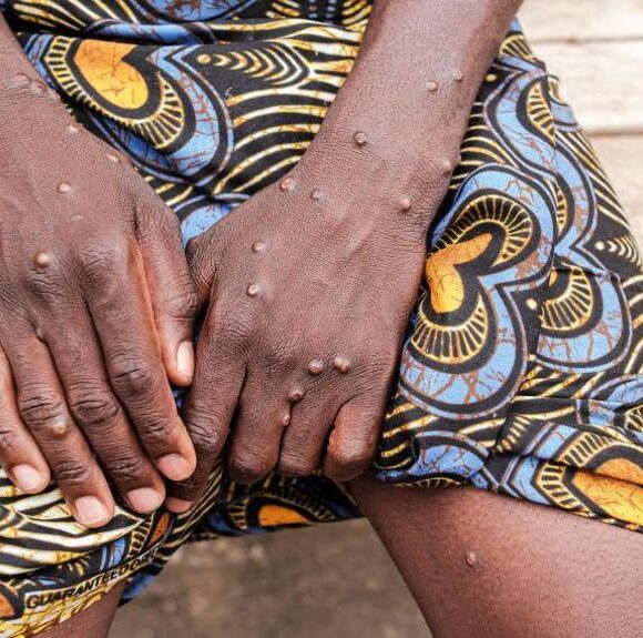 High Rates of Miscarriage and Stillbirth among Pregnant Women with Clade I Mpox