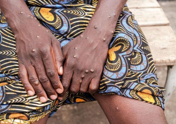 High Rates of Miscarriage and Stillbirth among Pregnant Women with Clade I Mpox