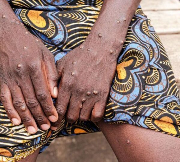 High Rates of Miscarriage and Stillbirth among Pregnant Women with Clade I Mpox